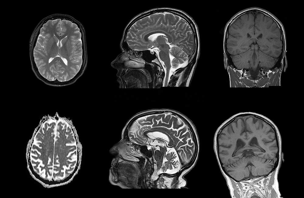 Compare the normal brain of a 22-year-old (top) with the scans of a normal 96-year-old. Brain shrinkage is shown by extensive white areas. 
Image: Dr P Marazzi/Science Photo Library